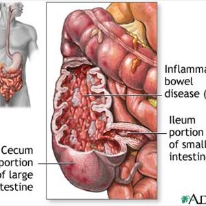 Severe Ibs Diarrhea - Information About Irritable Bowel Syndrome